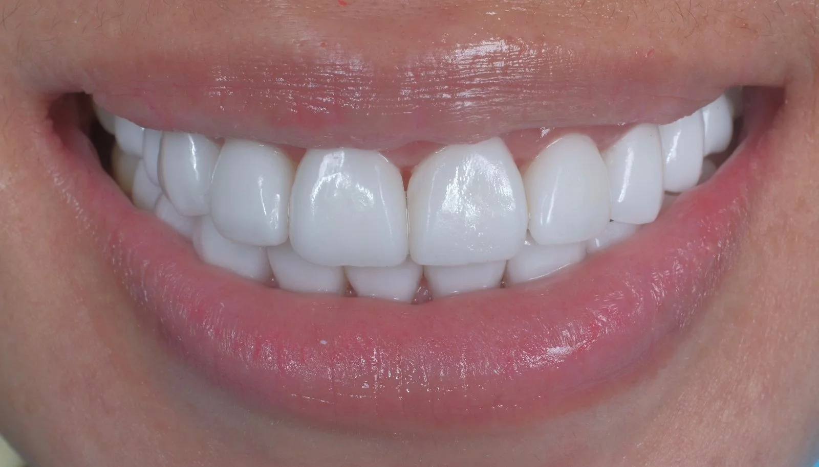 icare dental_website_Smile make over_2