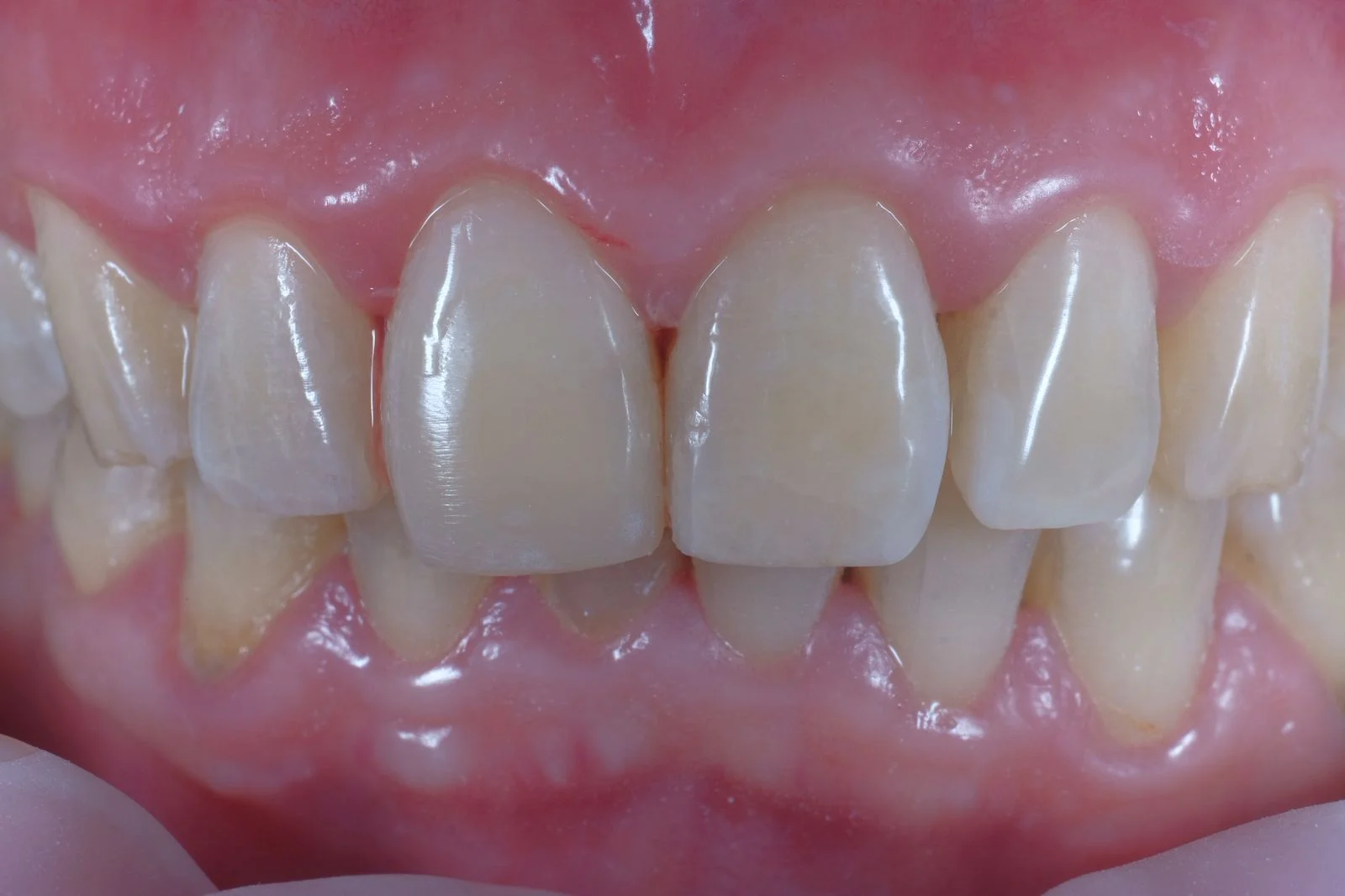 icare dental_website_Tambal estetik _ Esthetic Composite Restoration copy