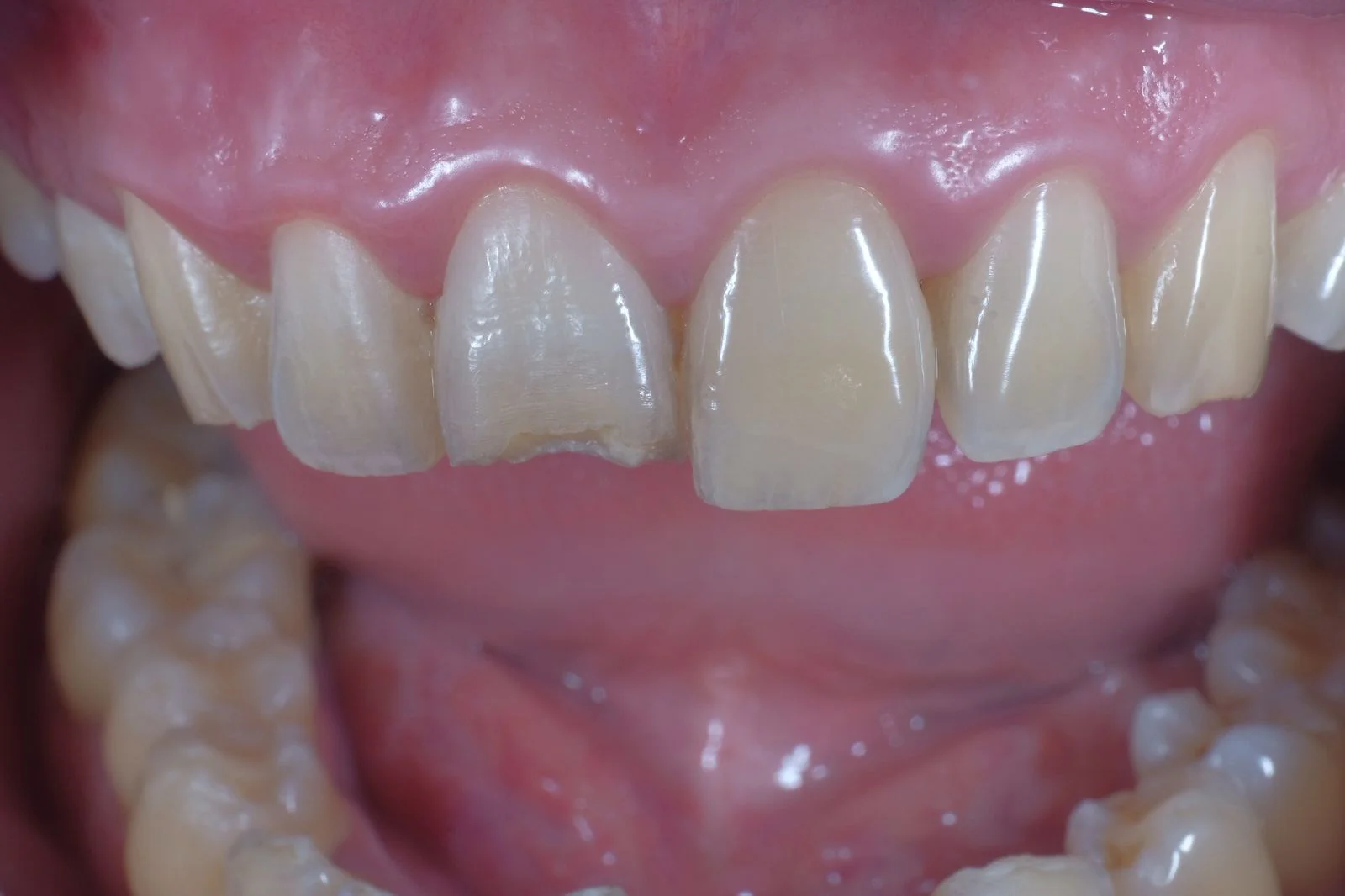 icare dental_website_Tambal estetik _ Esthetic Composite Restoration_2 icare dental_website_Tambal estetik _ Esthetic Composite Restoration_2